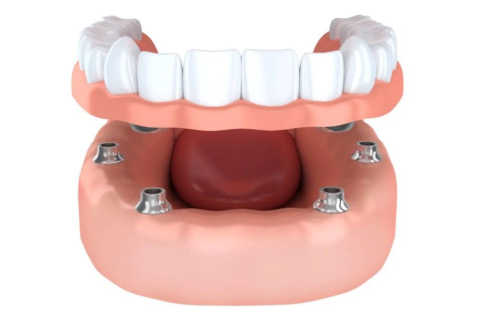 Servizio di implantologia a Torino presso la clinica dentistica Cristaldent